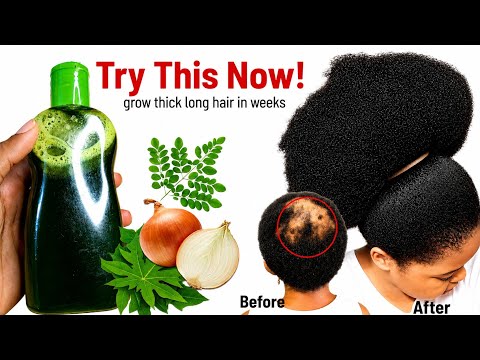 No More Short Patchy Hair! MY Hair Can't Stop Growing Wild With Onion, Moringa, Papaya leaf