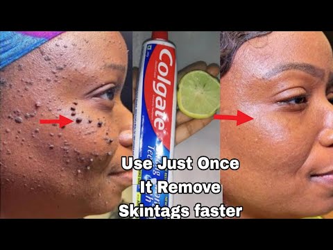 diy skin tag removal in 3 day quickly, how to remove skin tag removal with lemon in 3 day quickly,