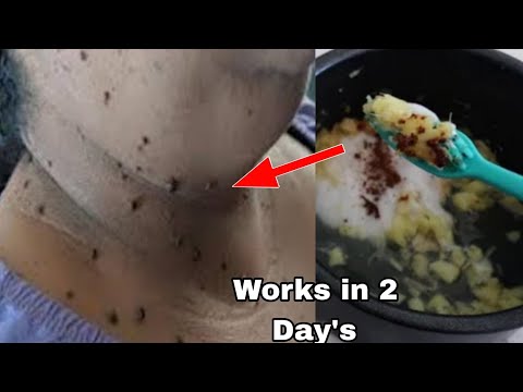 diy skin tag removal in 3 day quickly, how to remove skin tag removal with lemon in 3 day quickly,