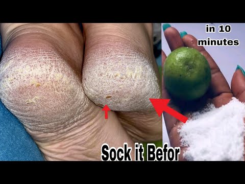 Get Smooth Feet in 5 Minutes | Most Easy Pedicure | Remove Suntan Easily At Home #pedicure #diy