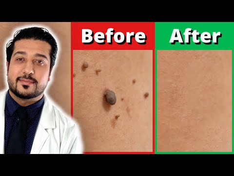 How to Rid Skin Tags FASTER | 3 Easy Skin Tag Removal Steps