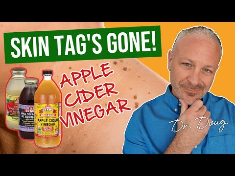 SKIN TAG  * FIX * THAT WORKS!